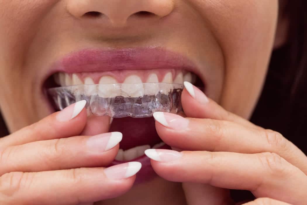 Close view of teeth in a dental context
