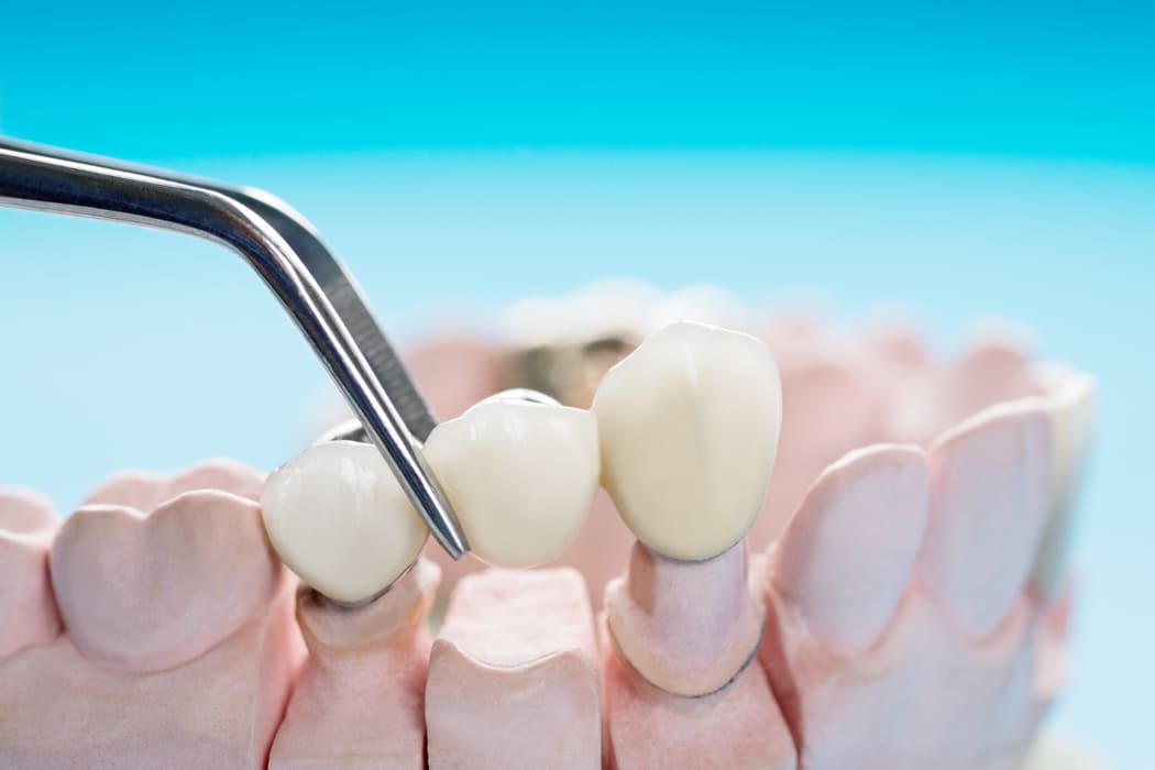 Close view of teeth in a dental context
