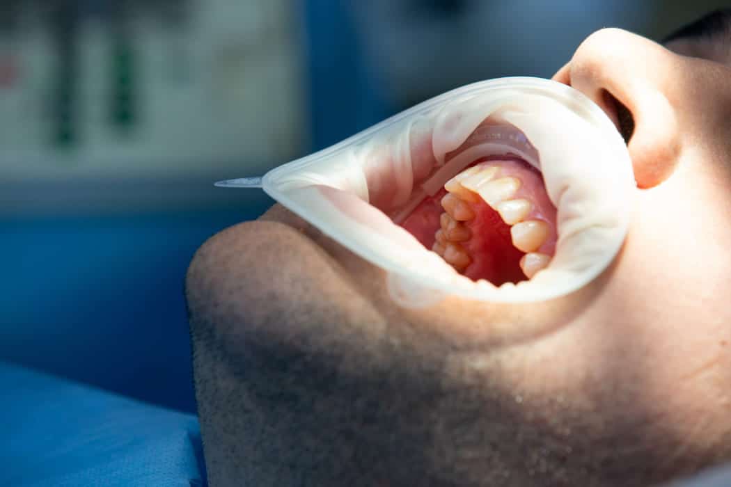 Dental clinician examining a tooth